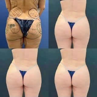 Liposuction Antalya