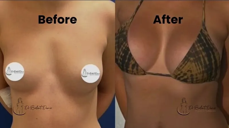 Breast augmentation vs Breast implants