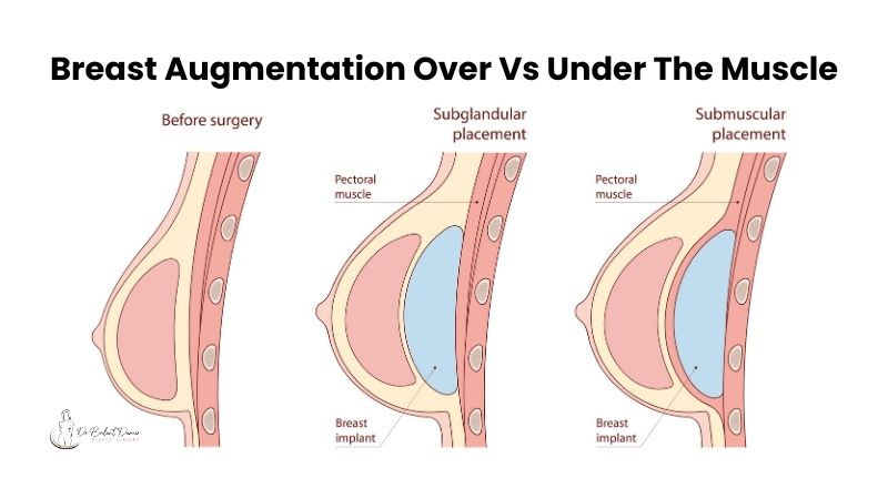 Breast augmentation placement