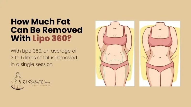 Fat Removed With Lipo 360