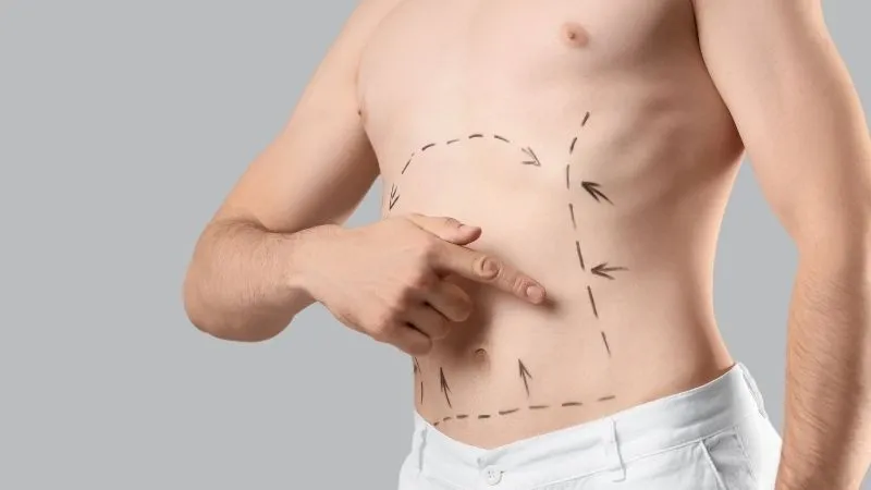 Karın germe ameliyatı sonuçları kalıcı mı? - Antalya