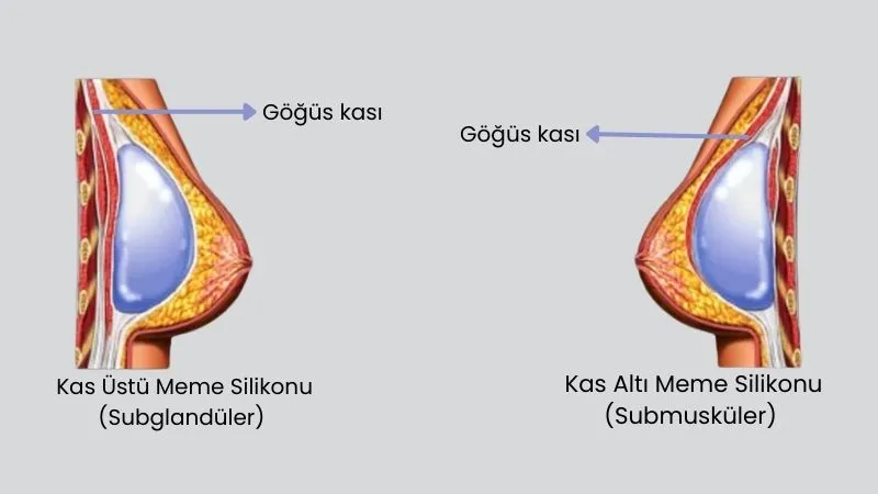 Silikon Meme Üstü mü, Kas Altı mı Olmalı? - Antalya