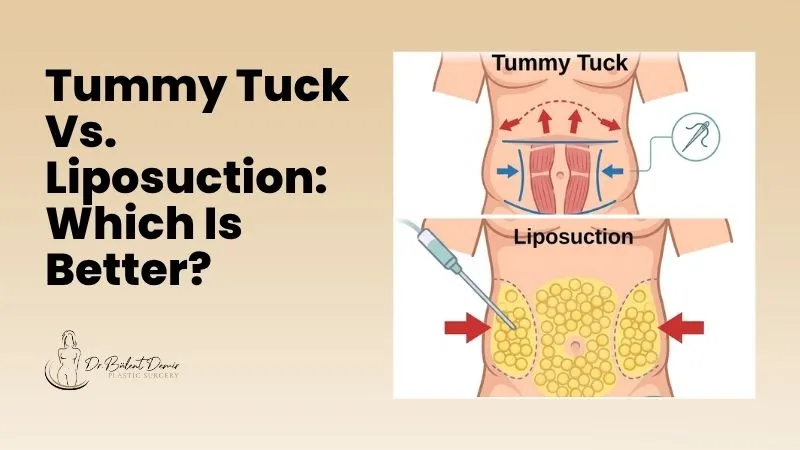 Tummy tuck vs. Liposuction