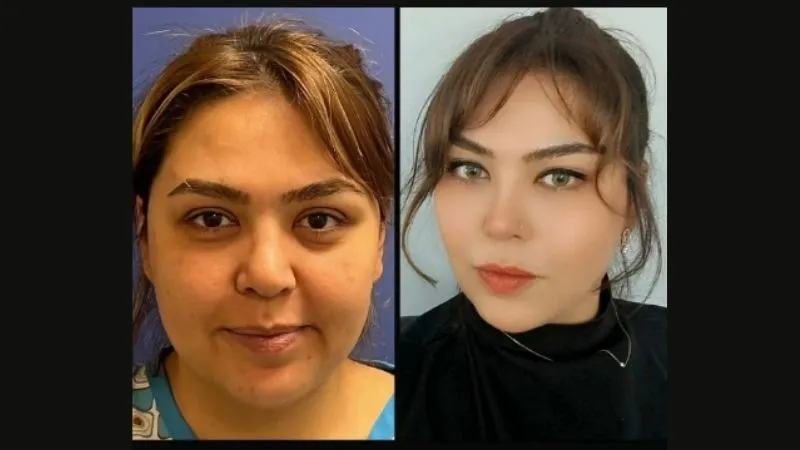 Yanak inceltme - Yanak estetiği Antalya