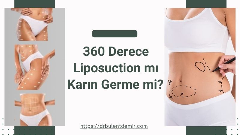 360 derece liposuction mı karın germe mi?  Antalya