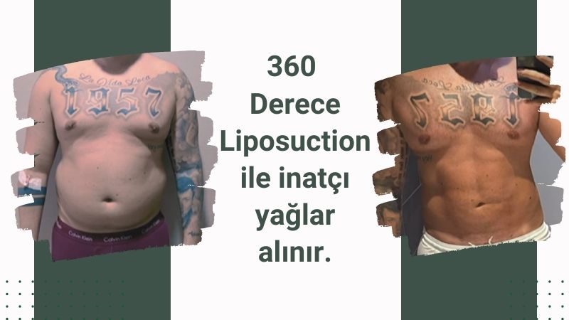 360-derece-liposuction Antalya