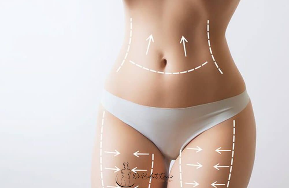 360 Derece Liposuction Antalya