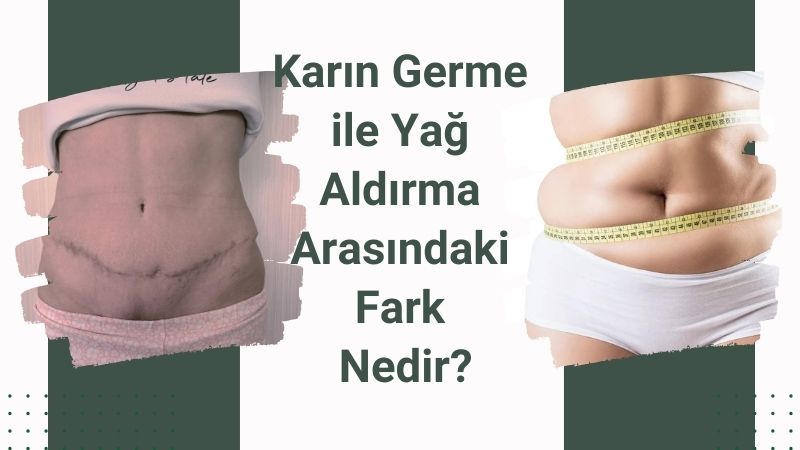 Karın germe ile liposuction arasındaki fark nedir? Antalya