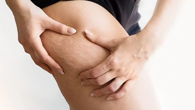 Liposuction ile selülit gider mi  Antalya