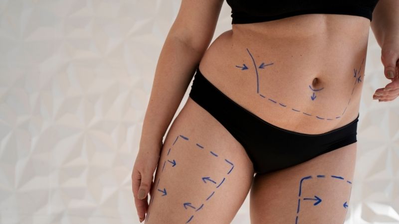 Liposuction Sonrası İyileşme  - Yağ Aldırma Sonrası İyileşme Antalya
