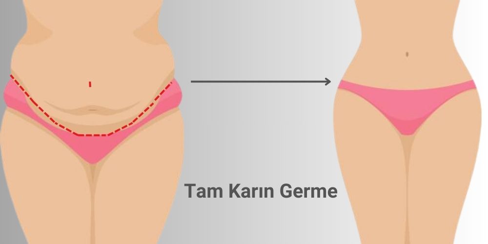 Tam Karın Germe Mini Karın Germe Farkı Nedir?  Antalya