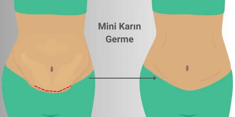 Tam Karın Germe ve Mini Karın Germe Farkı Nedir?  Antalya