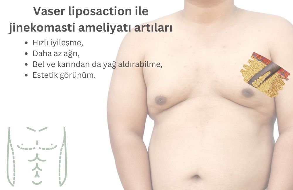 Vaser Liposuction ile Jinekomasti Artıları Antalya