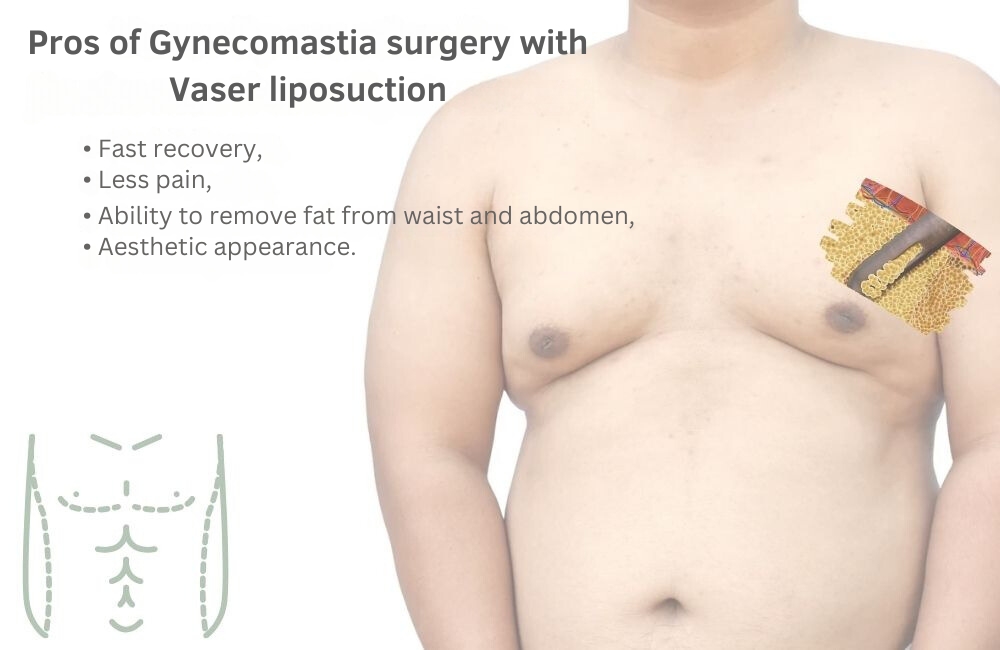 Advantages of gynecomastia with Vaser liposuction Turkey Antalya