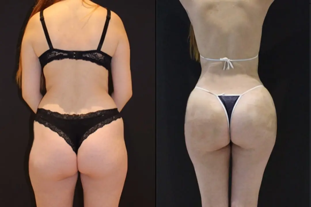 Benefits of 360 lipo and BBL combination Benefits of 360 lipo and BBL combination Turkey Antalya