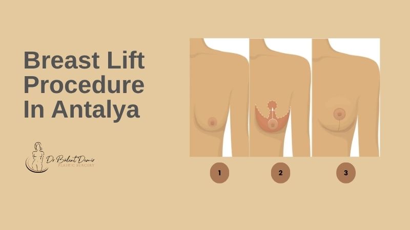 Breast lift procedure in Antalya Turkey
