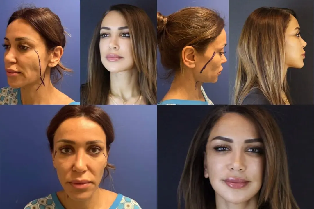 Facelift scars Facelift scars