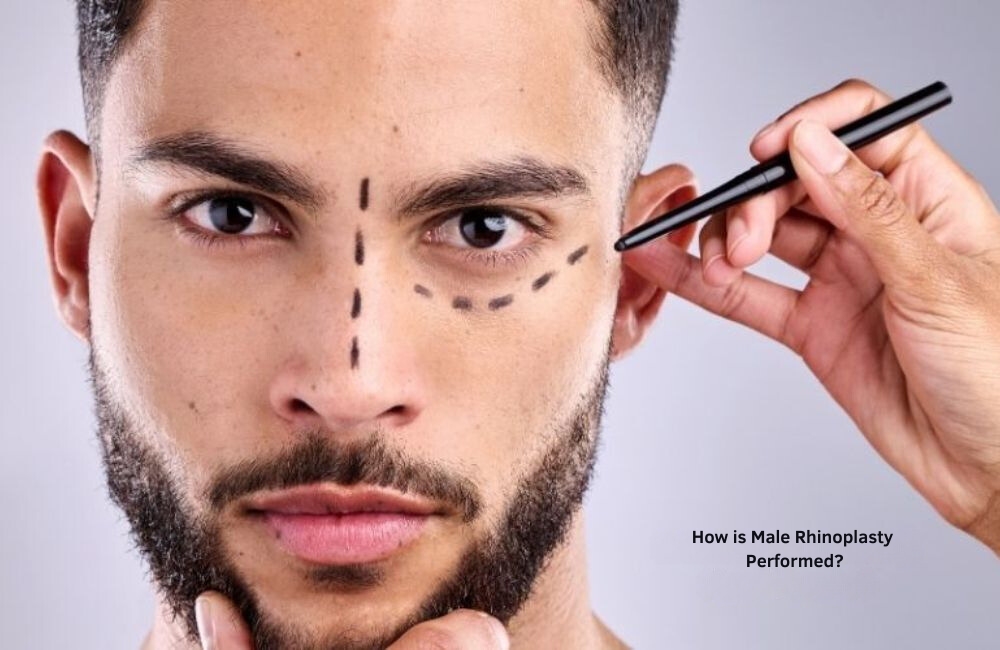 How is male rhinoplasty surgery performed? Turkey Antalya