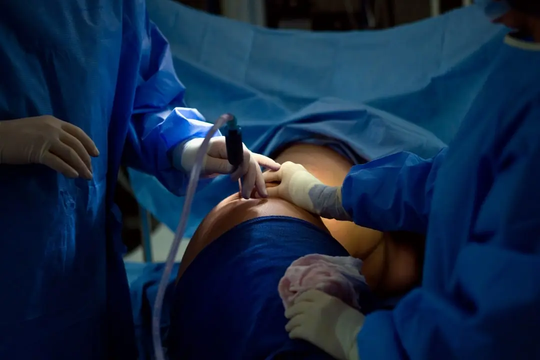 What happens immediately after my liposuction surgery? What happens immediately after my liposuction surgery?