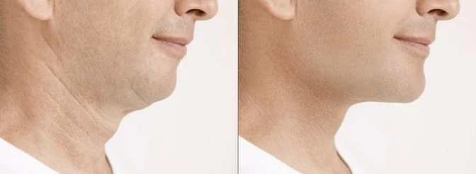 Neck and Chin liposuctio