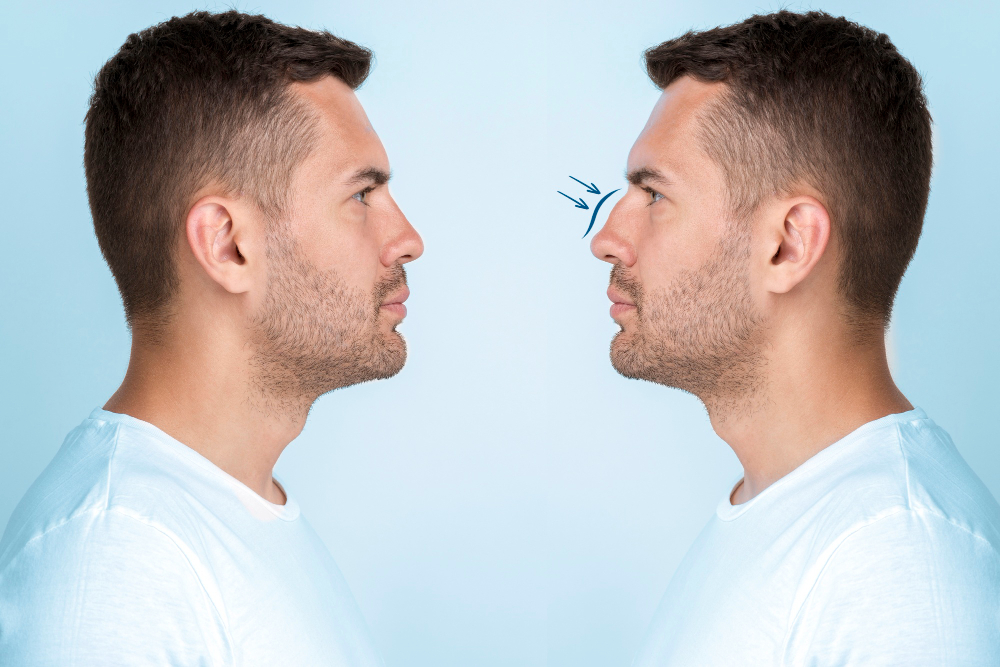 Rhinoplasty before and after male Turkey Antalya Turkey Antalya