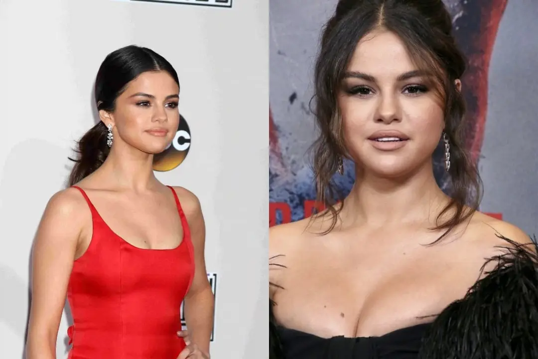 Selena Gomez breast augmentation before and after Turkey Antalya