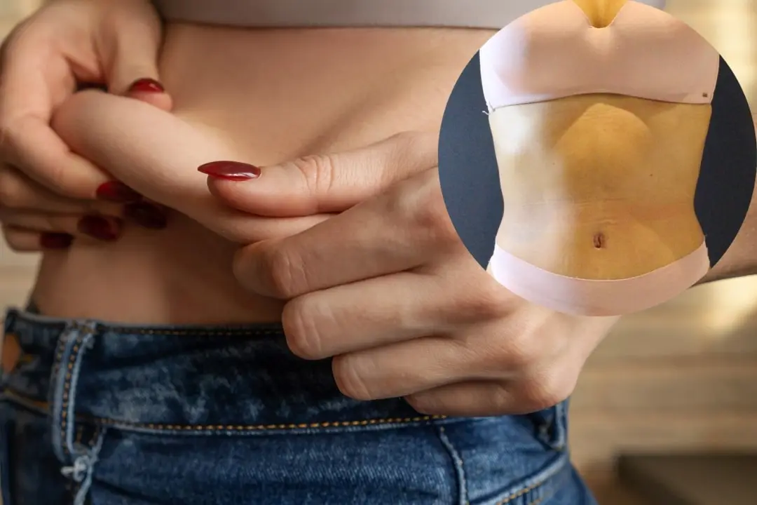 Tummy tuck Tummy tuck Antalya Turkey