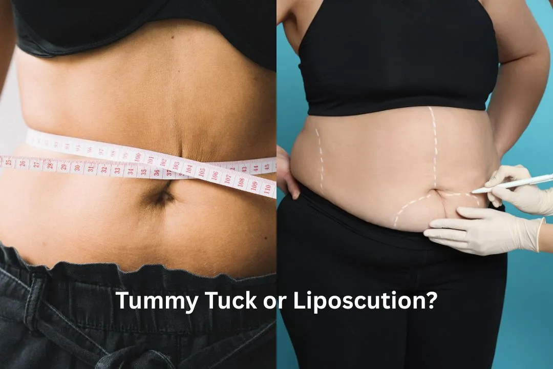 Tummy Tuck and Liposuctio