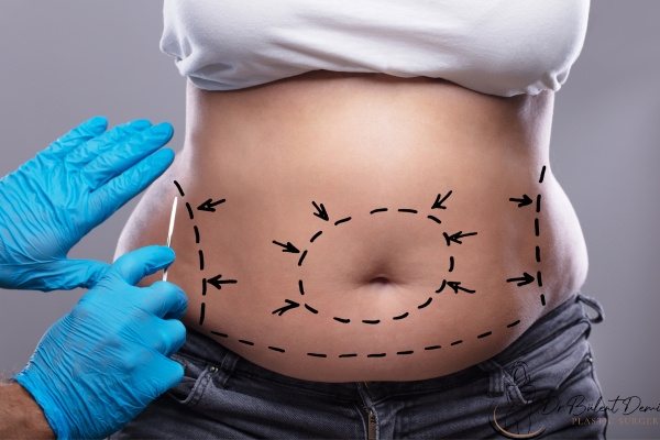 What is VASER liposuction? Turkey Antalya